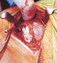 Open Shoulder Surgery at MIOT Hospitals in Chennai, Tamil Nadu, USA, affiliated to International University School of Medicine (IUSOM), which also has a Branch Campus, namely, IUSOM - Michigan Clinical Campus in Dearborn, Michigan, USA