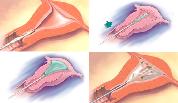 Uterine Balloon Therapy at MIOT Hospitals in Chennai, Tamil Nadu, India, affiliated to International University School of Medicine (IUSOM), which has also a Branch Campus, namely, IUSOM - MIchigan Clinical Campus in Dearborn, Michigan, USA